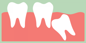 wisdom tooth erupting from gums