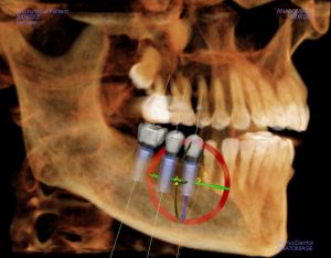 CT Scan of Dental Implants in a Lower Jaw bone
