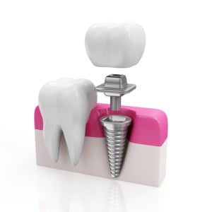 A computer graphic representation of a dental implant with an adjacent tooth