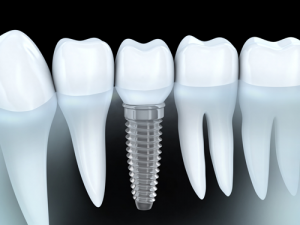 Digital representation of a dental implant in the middle of natural teeth against a black background