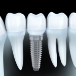 Digital representation of a dental implant in the middle of natural teeth against a black background