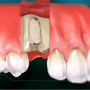 Computer generated image of a bone graft and implant placement