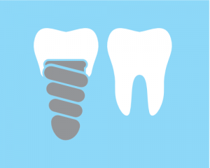 Drawing of a dental implant on the left next to a natural tooth on the right