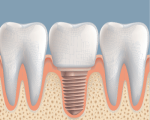 illustration Dental Implant between 2 teeth