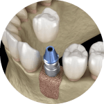 Illustration of dental Implant placed within bone grafted area in lower jaw