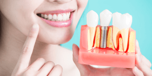 Woman holding a model of dental implants