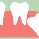 wisdom tooth erupting from gums illustration