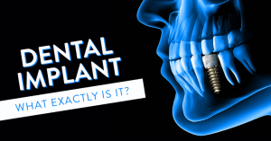 Dental Implant what exactly is it title on banner black background blue digital transparent human face with dental implant in place of one tooth