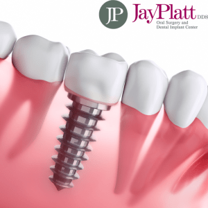 A dental implant digital graphic representation along side natural teeth