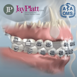 computerized graphic of an impacted tooth in mouth with braces that needs expose and bracket treatment