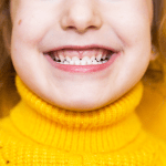 Short in tooth smile candidate for crown lengthening procedure
