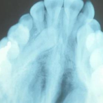 Impacted tooth x-ray