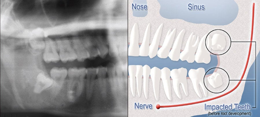 Diagram of x-ray and digital rendering of impacted teeth