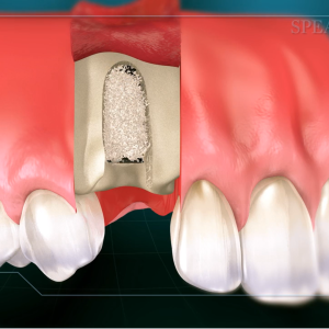 Bone grafting illustration with immediate implant placement