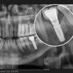 x-ray image of dental implant integrated to assist with total wellness