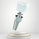 Digital representation of a dental implant structure 