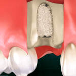 Socket preservation bone grafting graphic from spear education