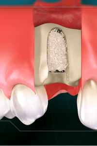 Socket preservation bone grafting graphic from spear education