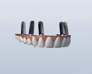 upper jaw full arch dental implants