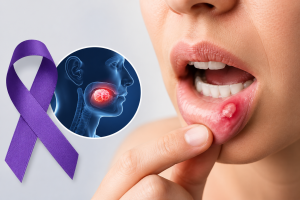 an individual pulling down the lower lip to reveal a sore in the mouth with a purple ribbon for oral cancer awareness