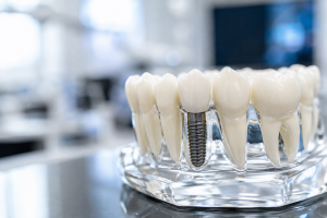 model of a dental implant in a mouth