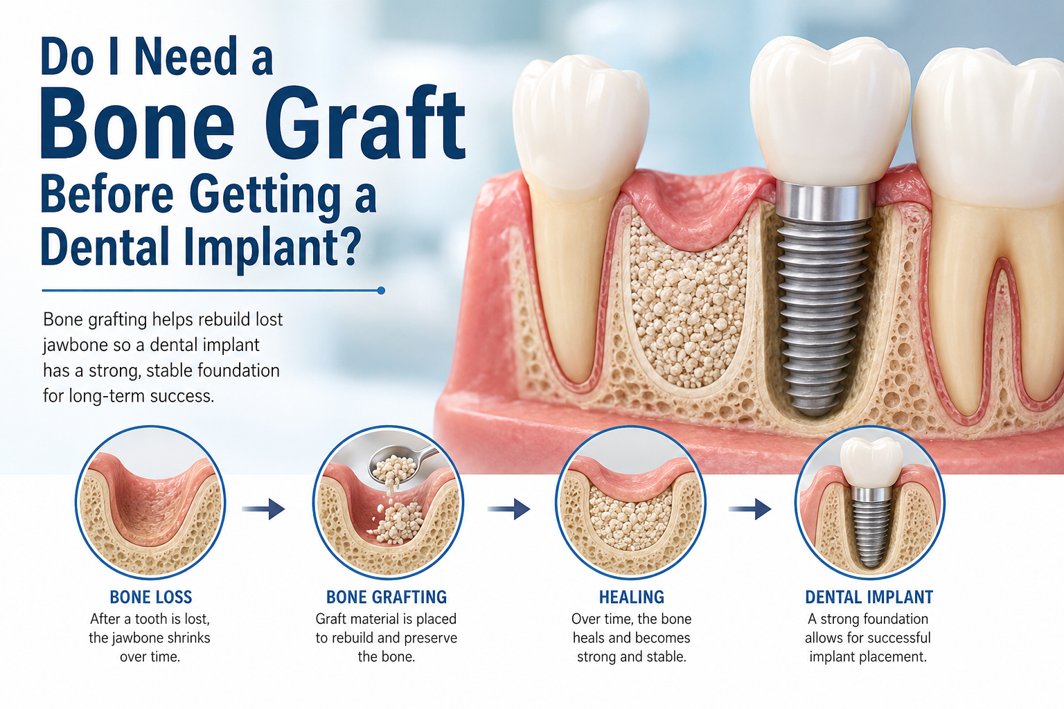 Bone grafting educational graphic with digital model representation and step by step process